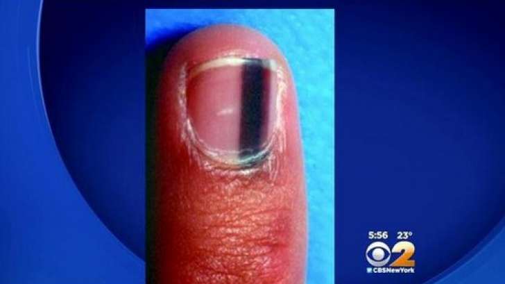 Semnul de pe unghie care anunţă cancerul. Dacă îl vezi, mergi urgent la medic!