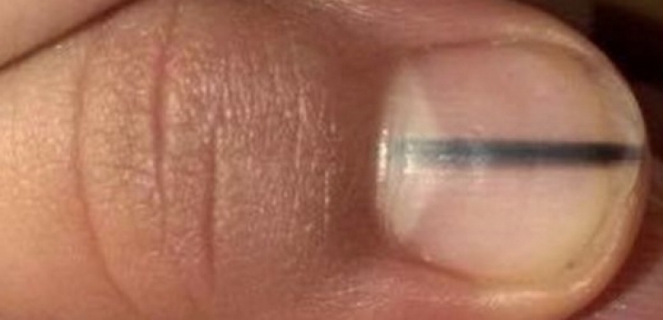 cancer de piele unghie positivo el papiloma virus