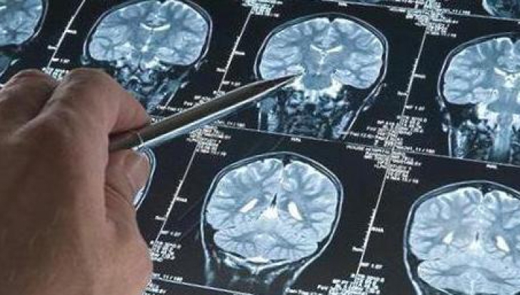 Neurochirurg cunoscut: "Cel mai comun simptom al unei tumori cerebrale e acest tip de durere de cap"