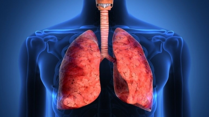 Al doilea transplant pulmonar