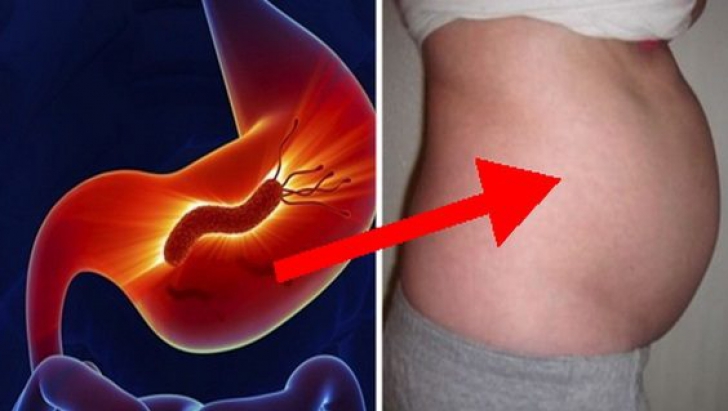 Bacteria care distruge stomacul. Se poate afla în corpul tău fără să îţi dai seama