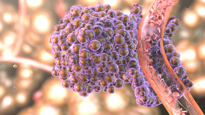 Alimentul care răsp&acirc;ndește cancerul &icirc;n tot corpul. &Icirc;l ai sigur &icirc;n casă. Renunță la el c&acirc;t mai rapid