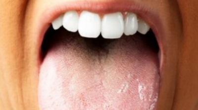 Ai limba crăpată la vârf? Mergi URGENT la medic! E vorba despre o boală cumplită!