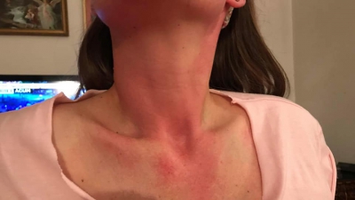 Nora Dincă arată urmările gazelor folosite &icirc;n Piața Victoriei