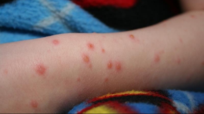 Explozie de cazuri de rujeolă, în România! 800 de noi îmbolnăviri, într-o singură lună: avertismentul medicilor/ Arhivă foto