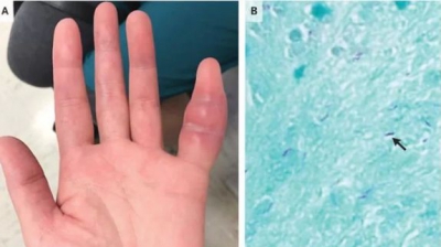 Un banal deget umflat i-a dezvăluit acestei femei o boală cumplită
