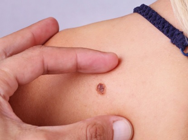 În ce zone ale corpului apare cel mai des cancerul de piele