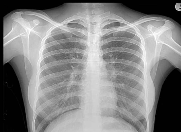 Cât de periculoase sunt radiografiile pentru organism 