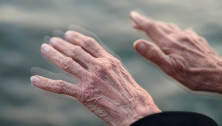 Operația care ar putea reduce riscul de a dezvolta boala Parkinson
