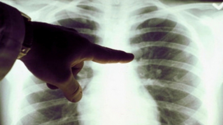 Veste bună pentru bonavii de TBC: legea tuberculozei a trecut de Comisia de Sănătate. Ce prevede