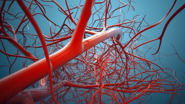 Stenoza arterelor carotide – cauze, simptome, tratament