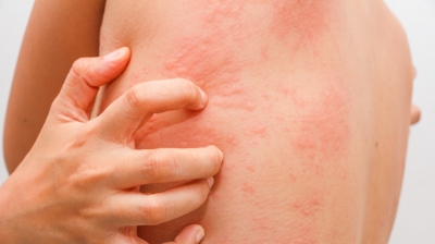 Urticare acuta