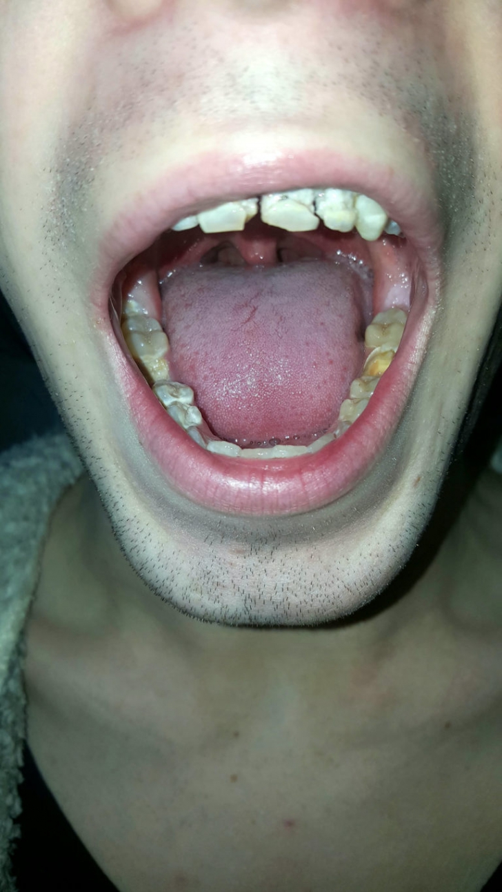 A băut 6 doze de energizant pe zi, timp de 7 luni, iar ce a apărut în gura lui e şocant!