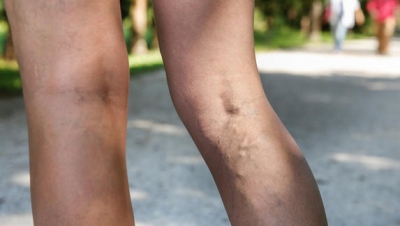 Рубрика: Care ajută la dureri la nivelul picioarelor cu vene varicoase reticulare