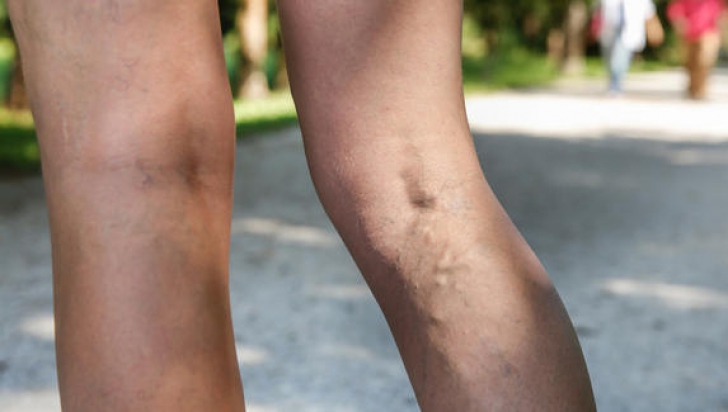 ranii partea superioara a picioarelor în varicoza