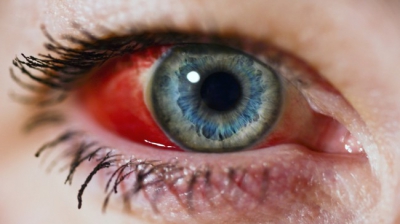 Ți s-a spart un vas de sânge în ochi? Semnele care trebuie să te trimită urgent la medic
