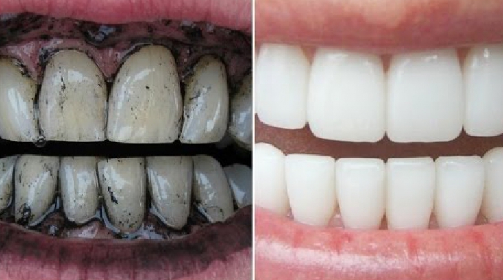 Cărbunele medicinal, secretul dinților albi 