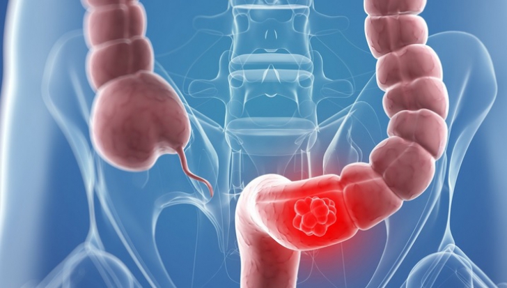 Simptomele care trădează cancerul de colon