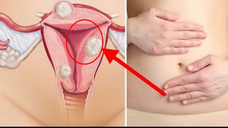 Endometrioza 