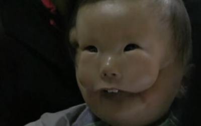 Povestea terifiantă a băiatului cu mască. Afecțiunea care i-a îngrozit până și pe medici!