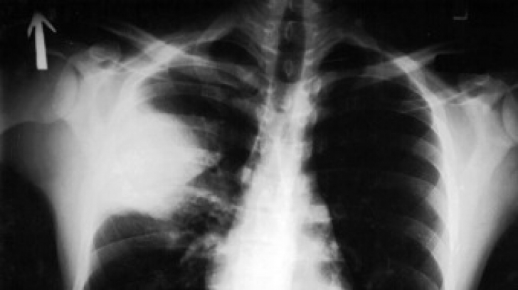 Alertă de ciumă pulmonară