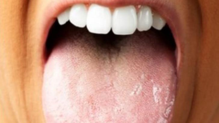 Ai limba crăpată la vârf? Mergi URGENT la medic! E vorba despre o boală cumplită!