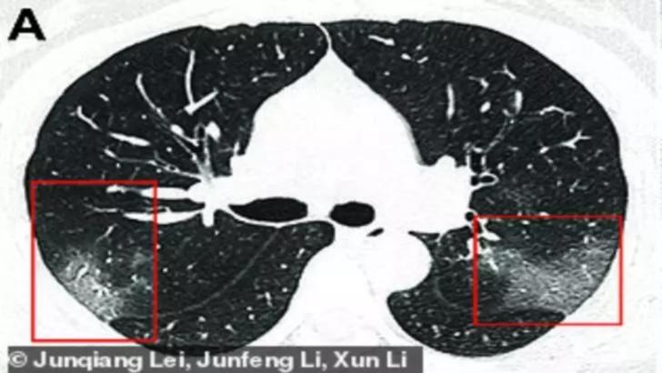 Cum arată plămânii unei persoane infectate cu coronavirus. Radiografia care a uimit lumea medicală