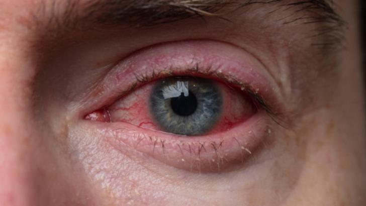 4 simptome noi pentru persoanele infectate recent cu coronavirus - Ce se poate observa chiar în ochii bolnavului