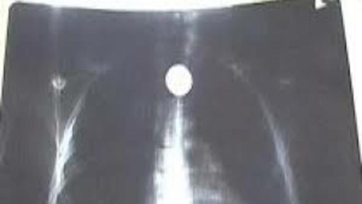 Radiografie pulmonară