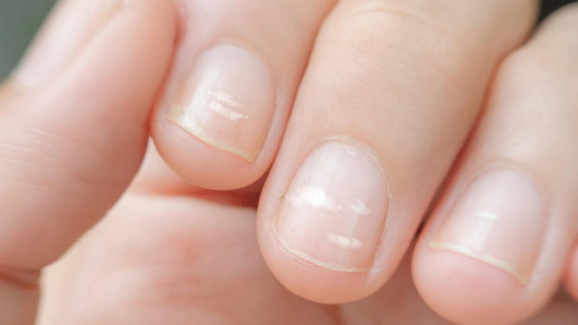 Petele albe de pe unghii sunt cauzate de bulele de aer de sub unghii