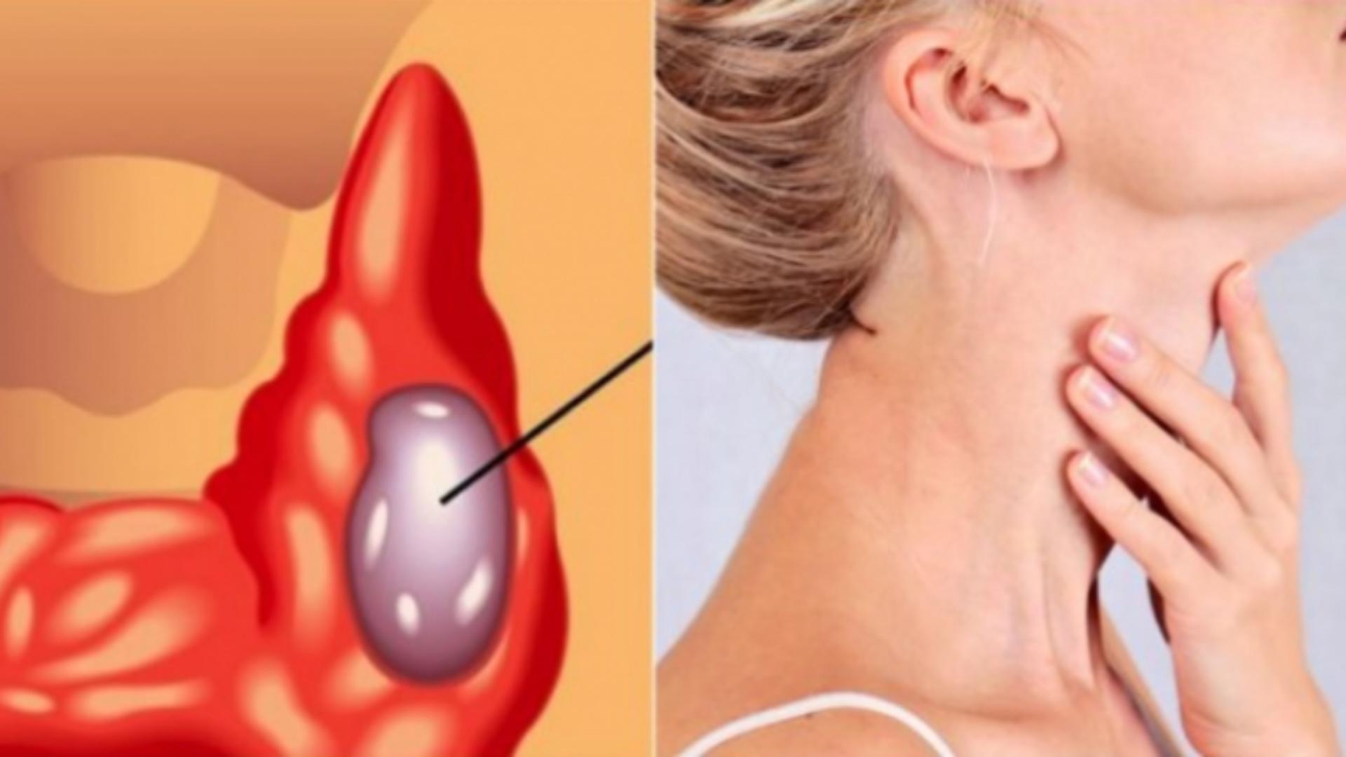Cele mai frecvente 3 simptome ale cancerului de tiroidă pe care nu ar trebui să le ignori 