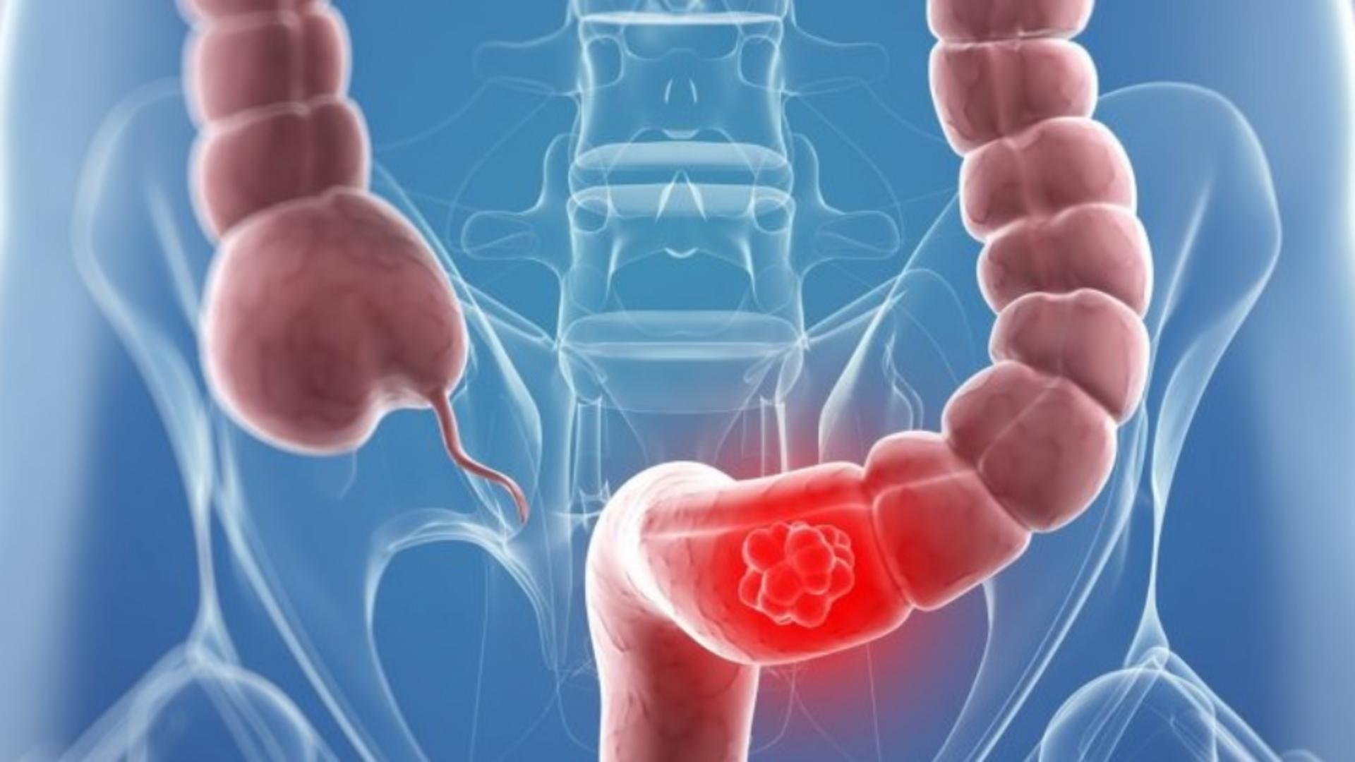 Leguma banală care previne cancerul intestinal și prelungește viața