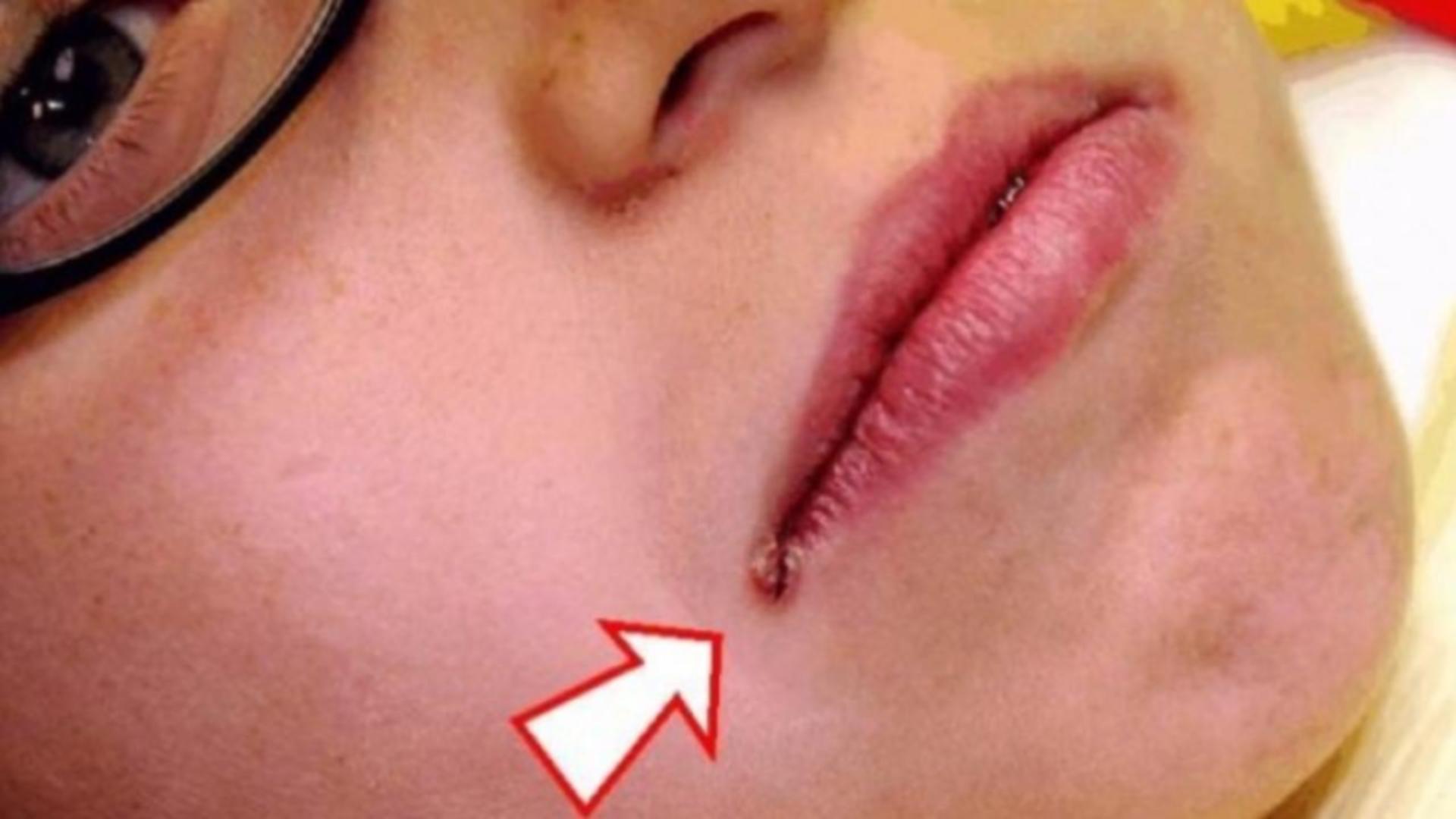 Cea mai frecventă afecțiune a buzelor este numită în popor zăbală