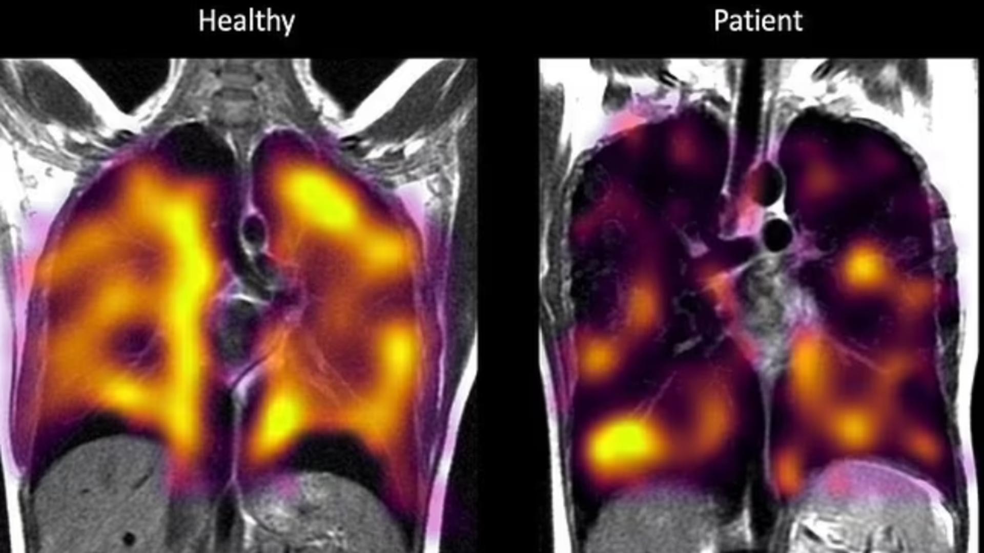 RISCUL extrem pentru bolnavii cu COVID lung: LEZIUNILE microscopice din plămâni, invizibile la radiografie sau CT