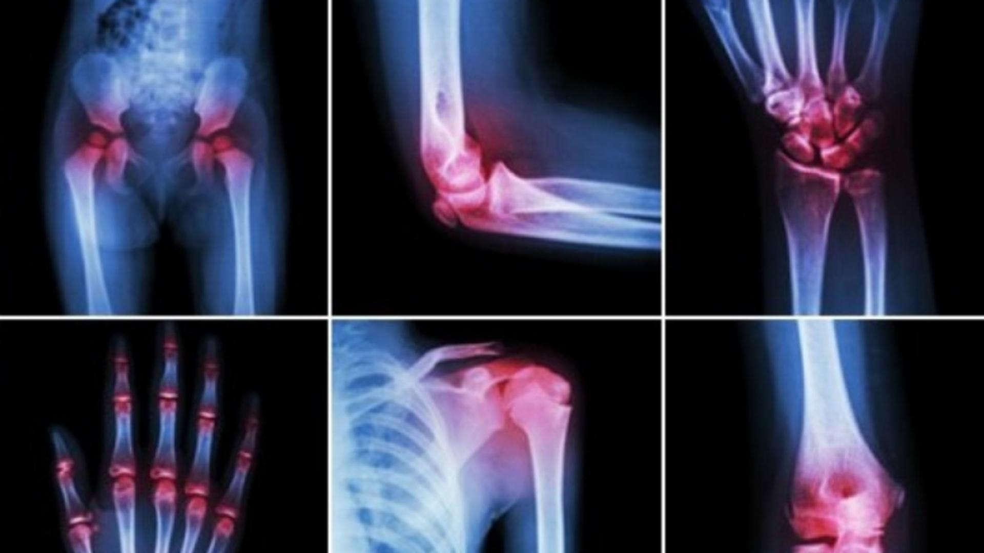 artrita dureri articulare artroză numele bolii articulare a piciorului