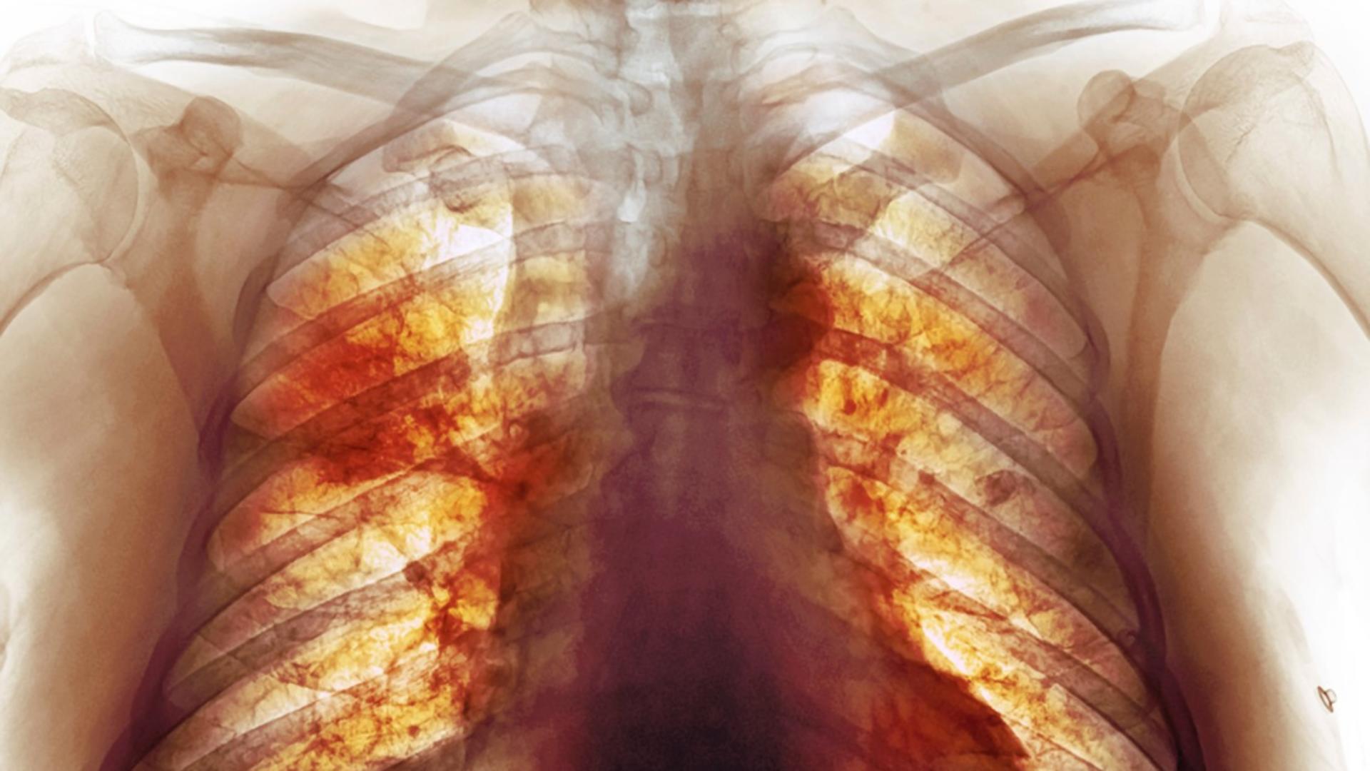 Cea mai detaliată radiografie dezvăluie cum arată, de fapt, plămânii după infectare / Foto: Profi Media