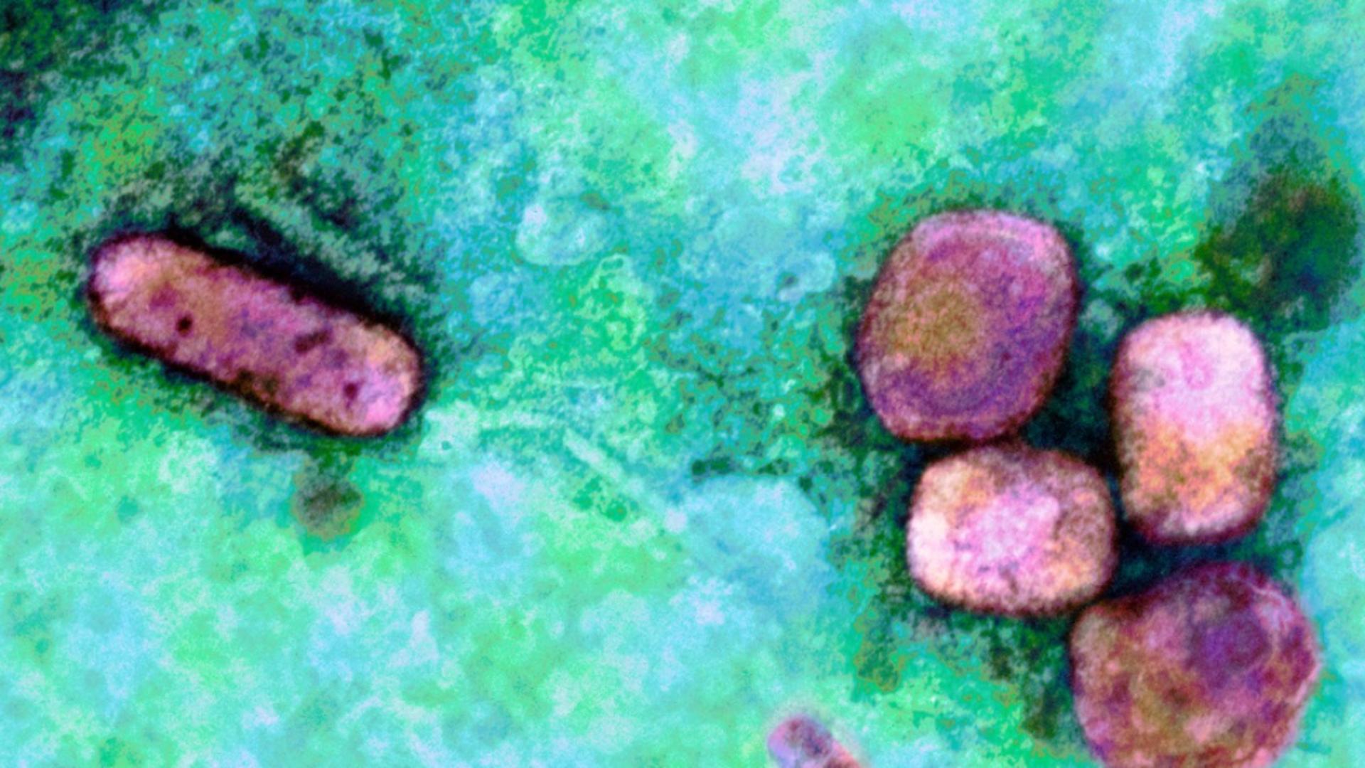 Primul caz de variola maimuței la oameni, depistat în America - Cum s-a infectat