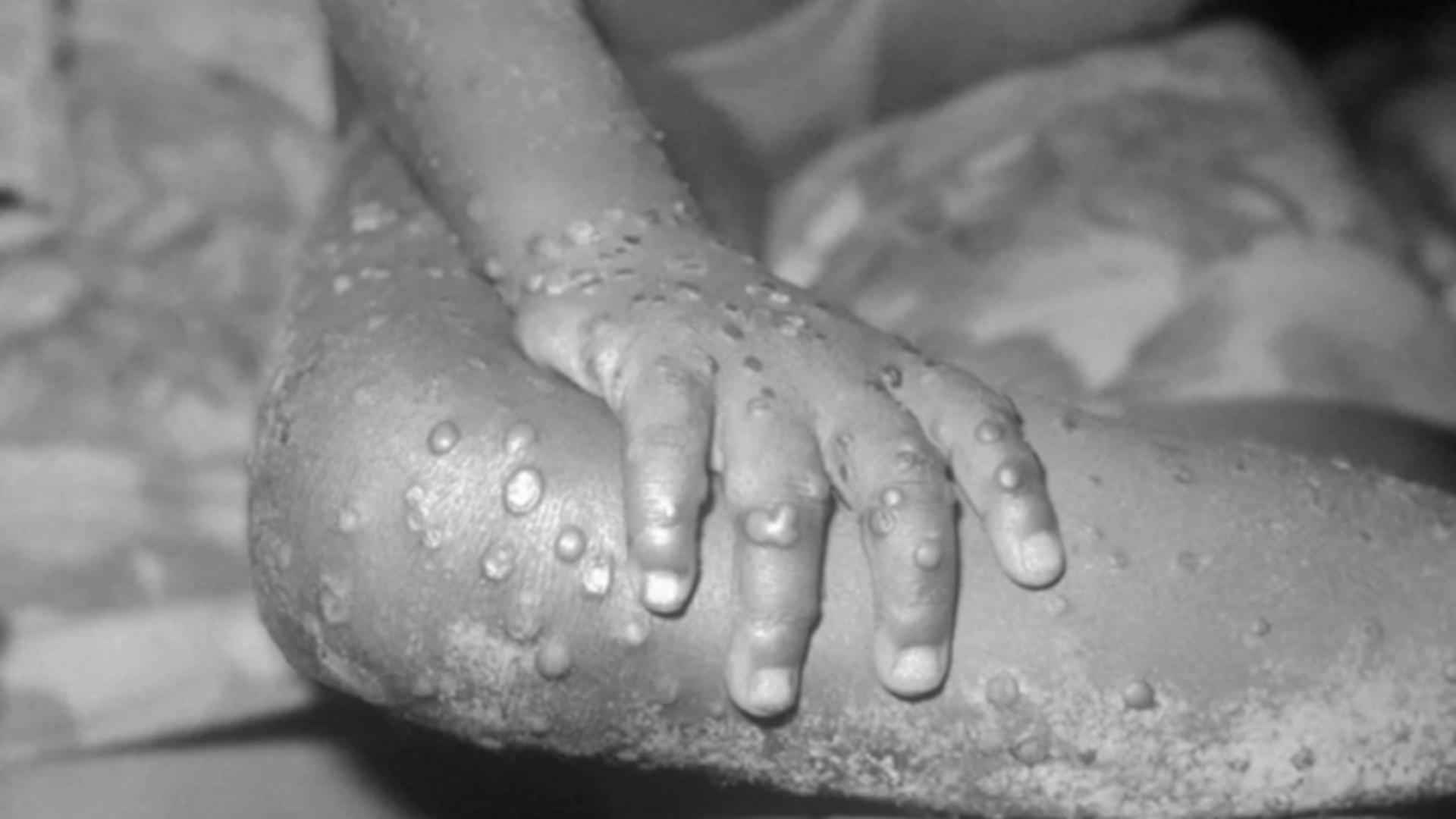 Nou caz de variola maimuței în România Foto: Profi Media