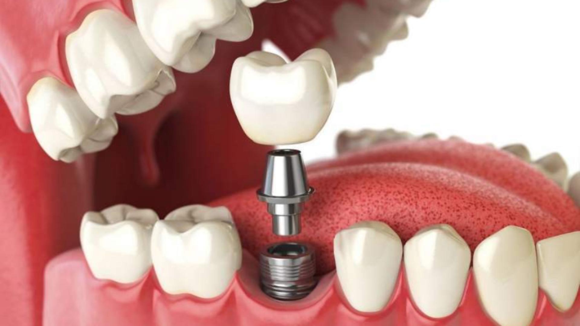 Ce trebuie să știi dacă ai nevoie de un implant dentar?