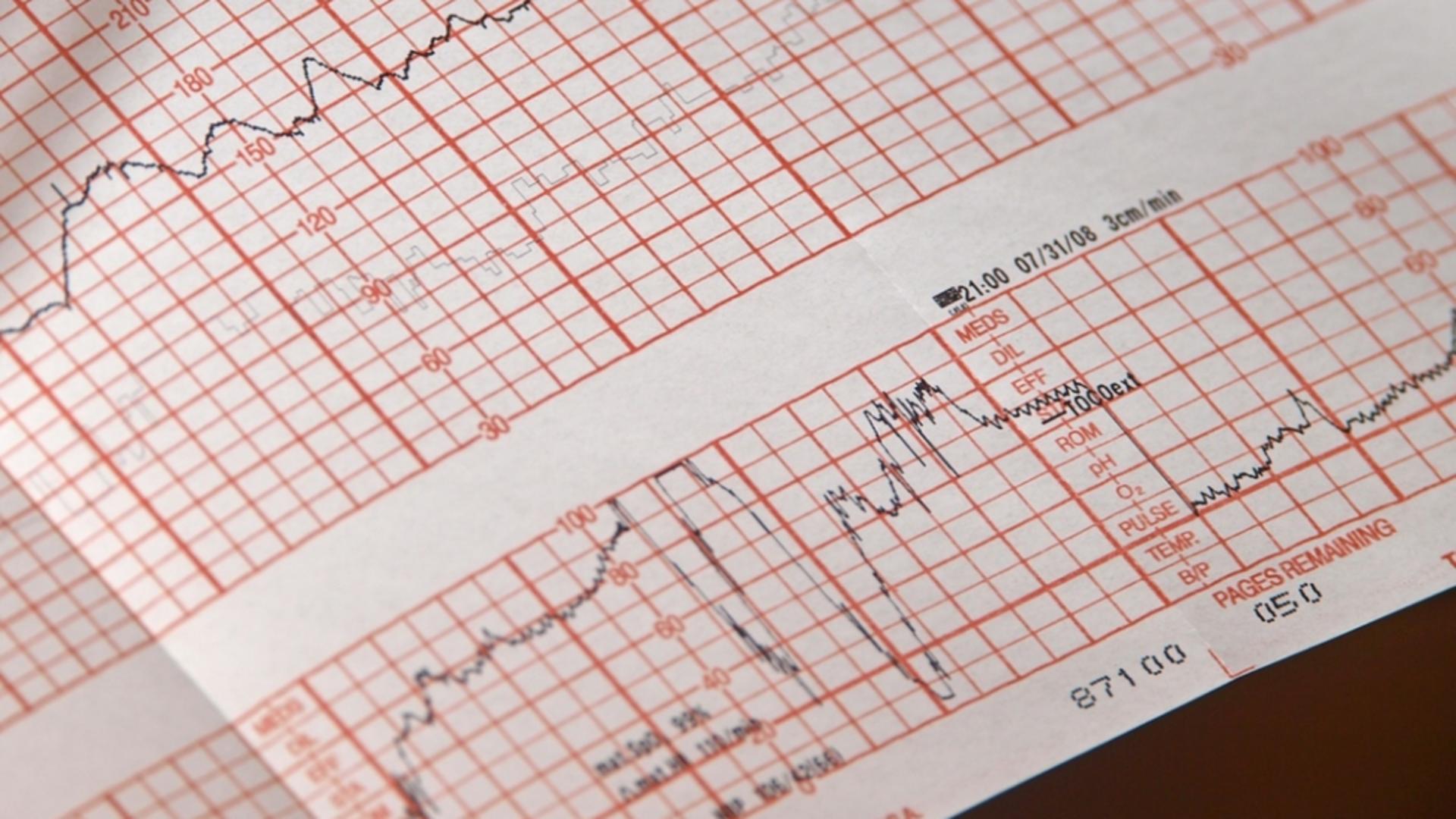 Când este indicată electrocardiograma - EKG? Avertismentul medicilor 
