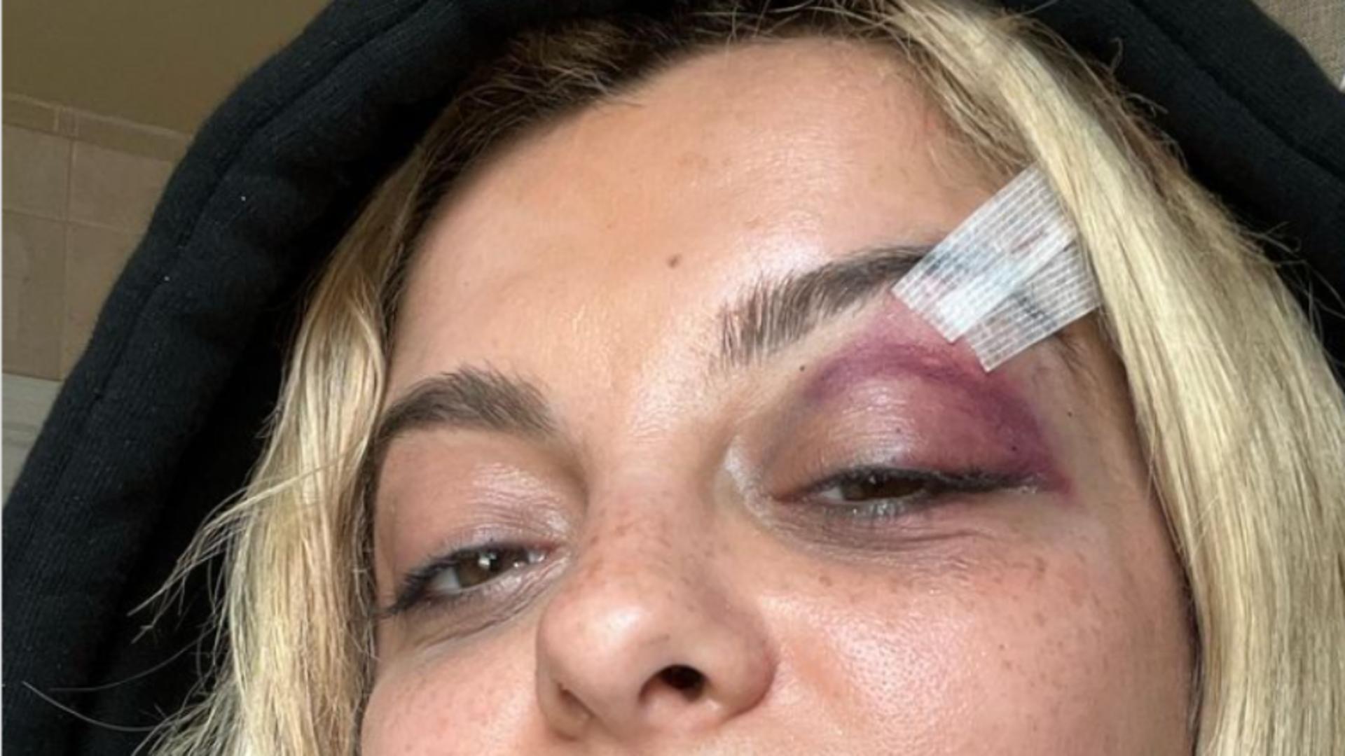 Bebe Rexha după accident (Instagram)