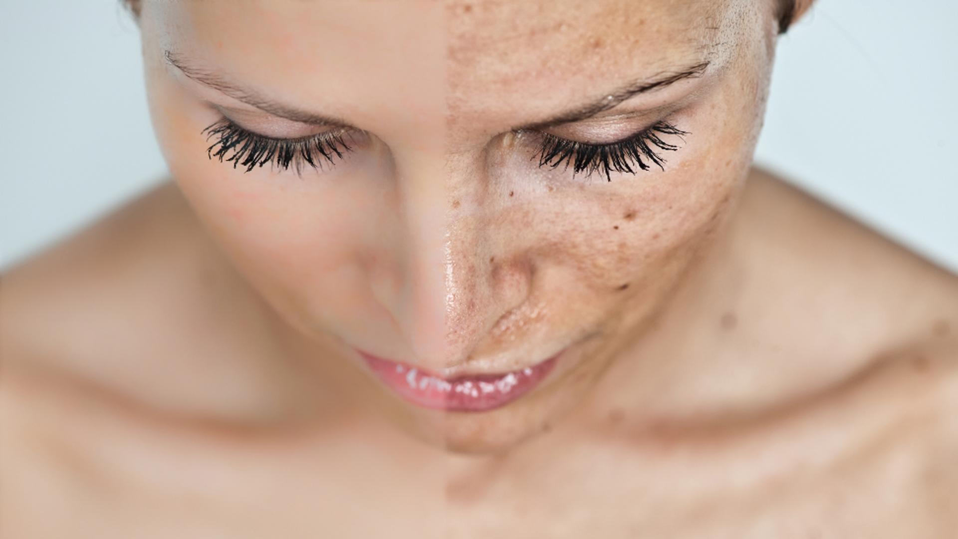 Remedii pentru petele pigmentare - Aceaste rețete combină ingrediente pentru tonifierea și albirea pielii