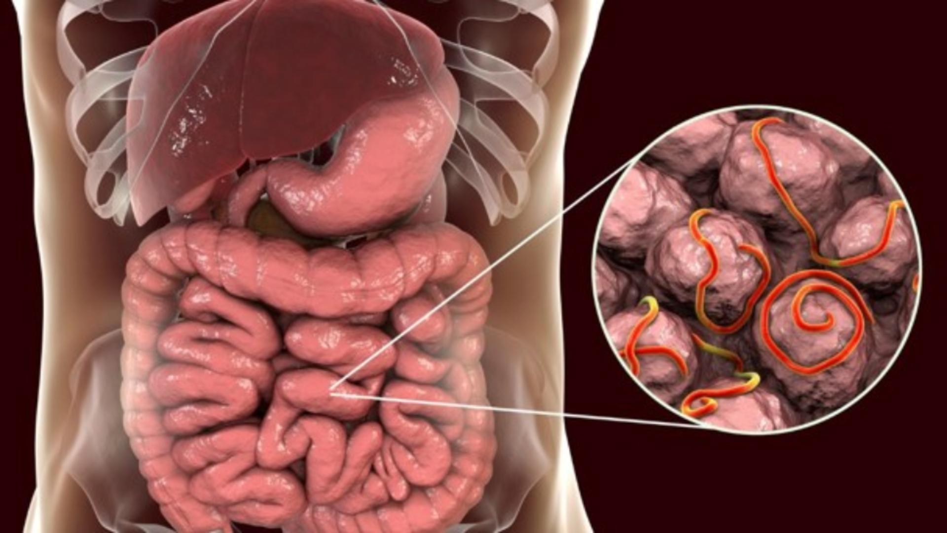 Totul despre praziți intestinali - Simptome, cauze și tratament