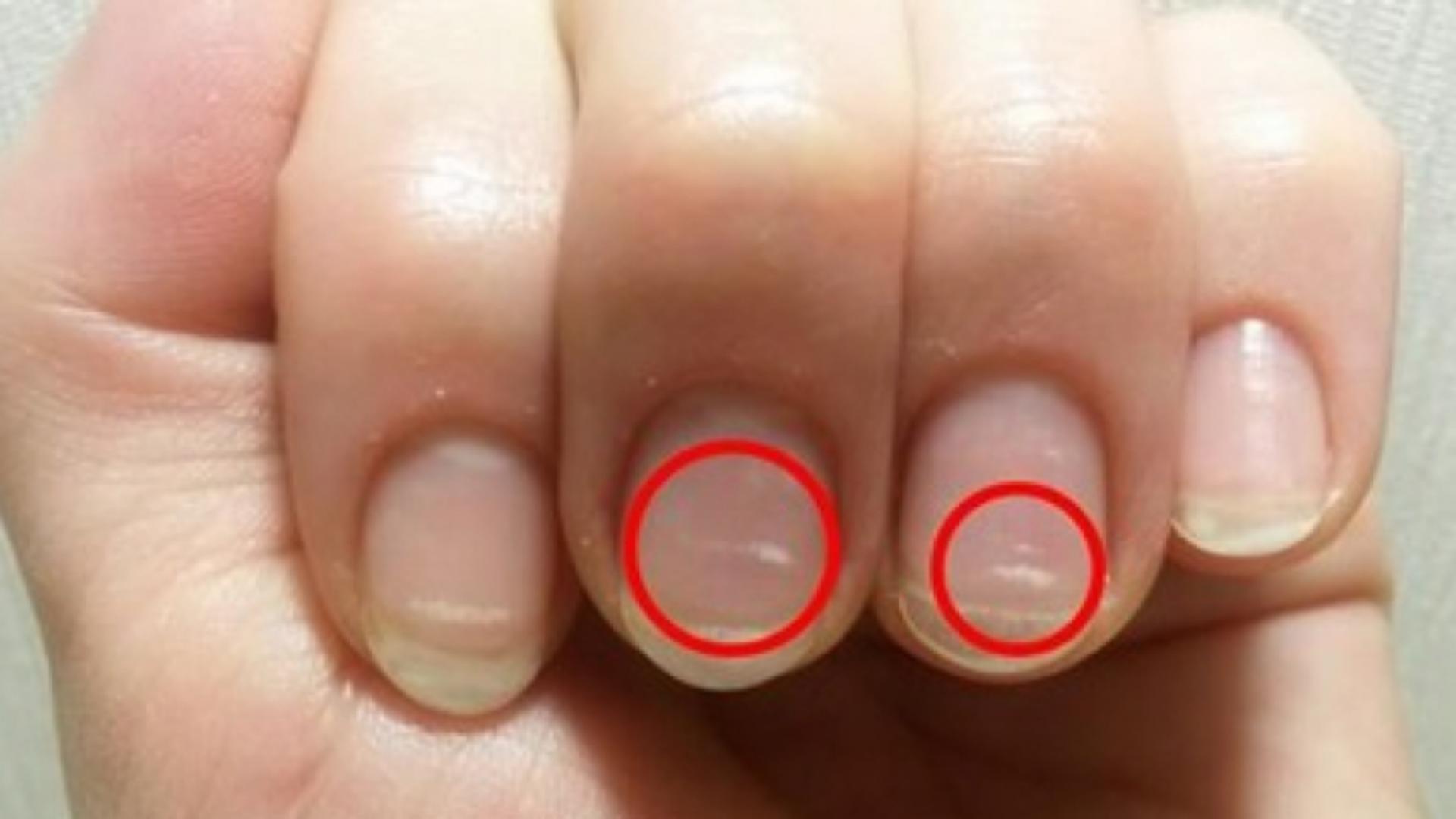 Semnul de pe unghii care îți arată că trebuie să mergi de urgență la medic