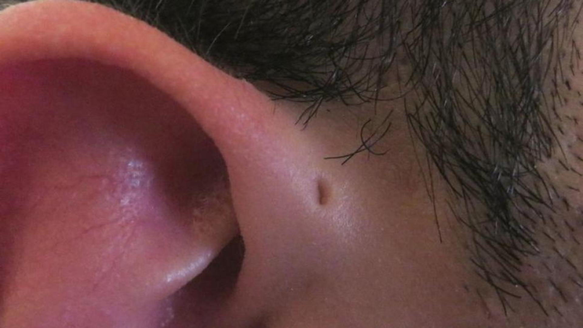 Ce înseamnă dacă ai o gaură pe ureche? Doar 1% din oameni au acest semn special