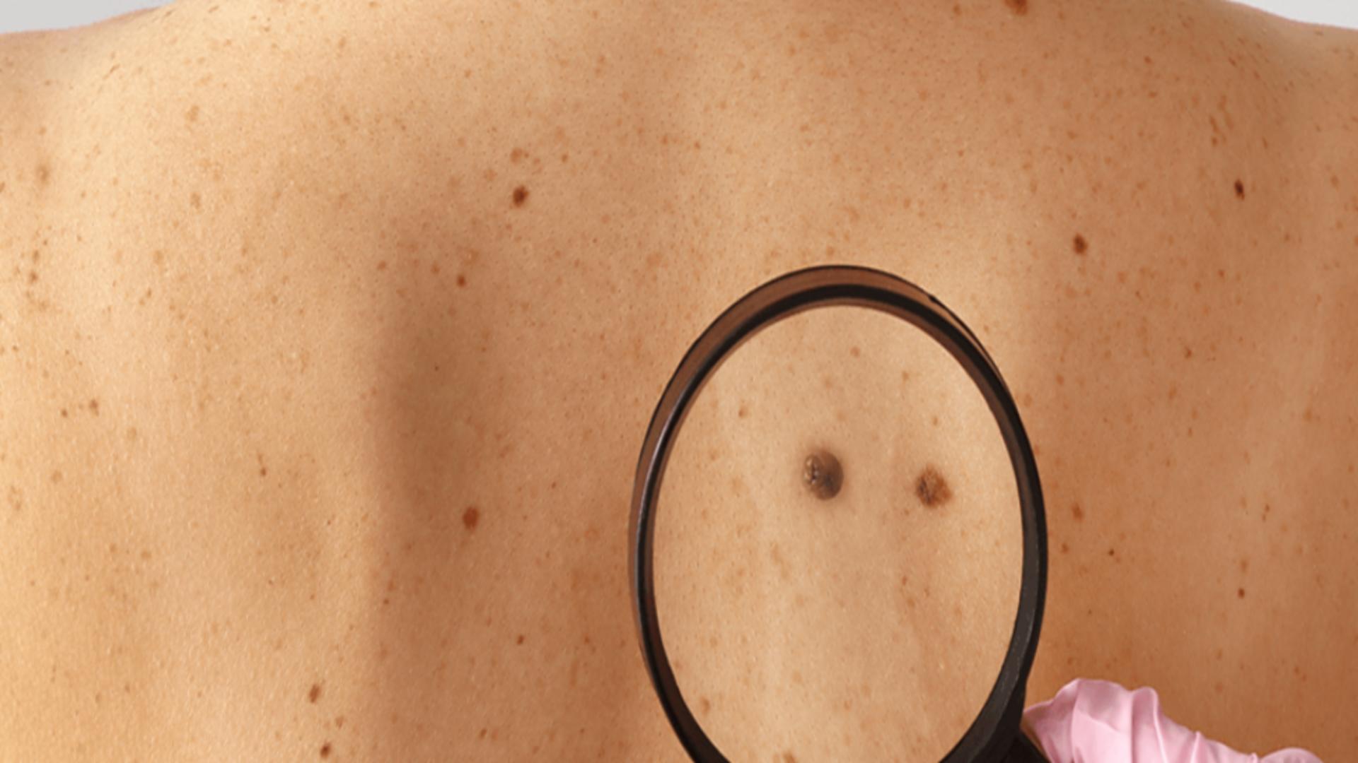 Regula simplă cu ajutorul căreia poți identifica din timp cancerul de piele