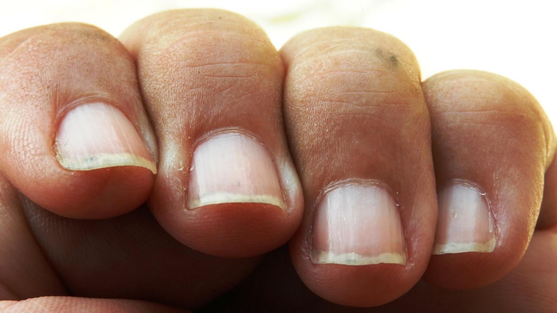 Bolile pot fi citite pe unghii.  Cum poți recunoaște afecțiunile de care suferi, analizându-ți unghiile