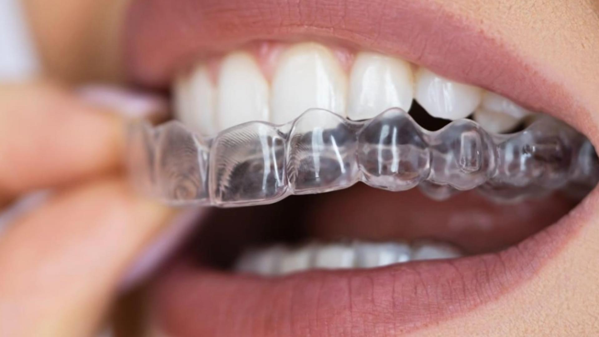 Aparatele dentare invizibile: Soluția modernă pentru un zâmbet perfect