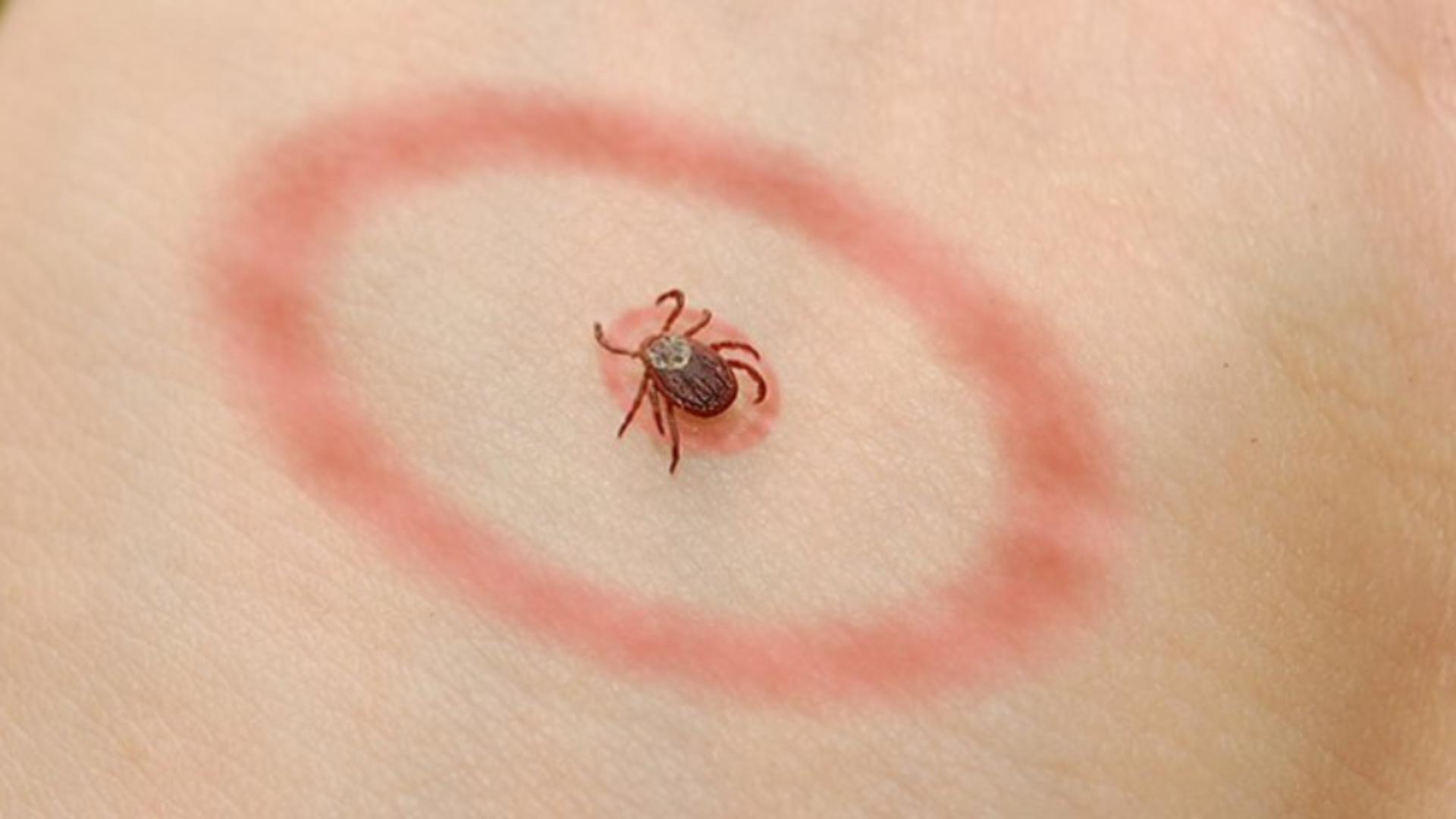 Cât de periculoasă este mușcătura de căpușă. FOTO: Facebook