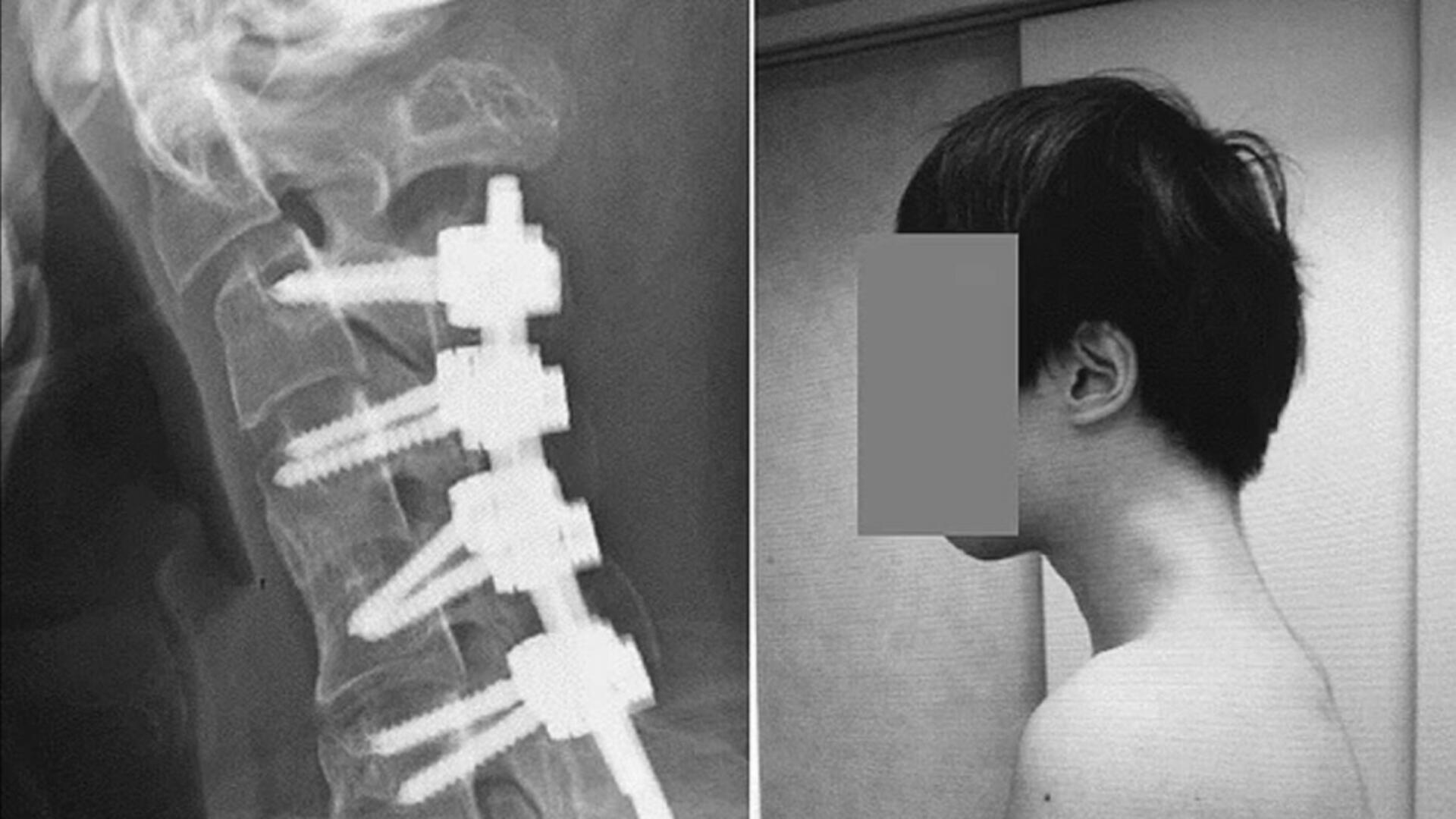 Avertisment dur al medicilor: un tânăr a ajuns să nu-și mai poată ridica capul din cauza statului excesiv pe telefon. Cât de mult ne afectează viața acest obicei?